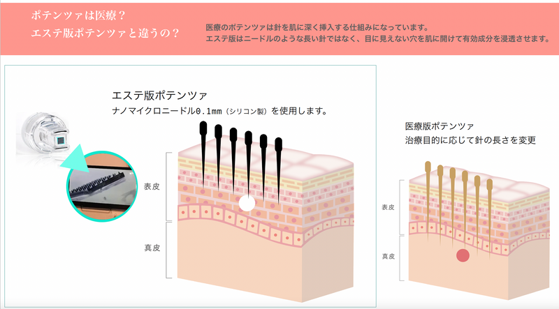 エステ版ポテンツァ(針なしなのマイクロニードル水光注射) – Diino エステ版ポテンツァ(針なしなのマイクロニードル水光注射) – Diino